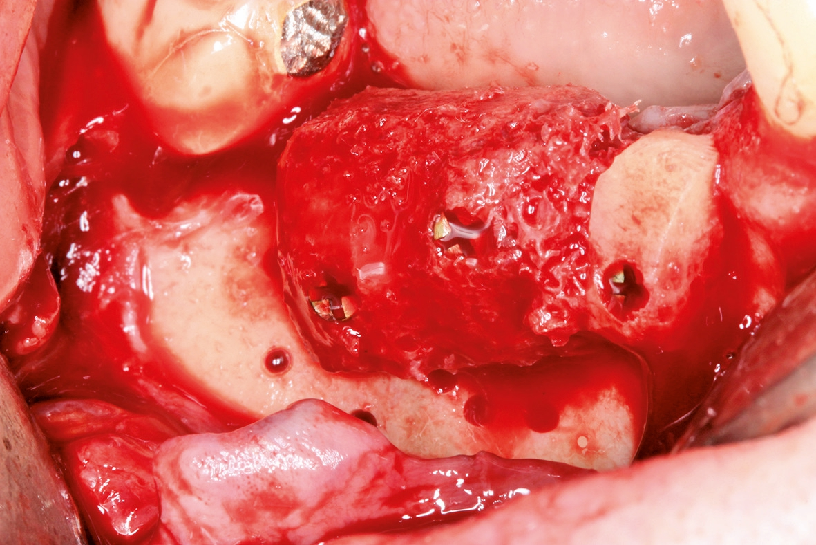 Abb. 11a: Re-entry nach vier Monaten: stabiles, ausreichend dimensioniertes und gut vaskularisiertes Augmentat mit geringfügiger Resorption im Bereich der mittleren Osteosyntheseschraube.
