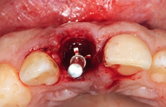 Abb. 9: Die Implantation erfolgte ohne Lappenbildung. Das Implantat wurde mit ausreichendem, gleichem Abstand zu beiden Nachbarzähnen palatinal orientiert inseriert.