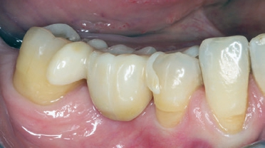 Abb. 11: Der Molar 46 aus Zirkonoxid wurde mittig geteilt. Die zwei Flügel wurden lateral mit Zementierungsschlüssel adhäsiv befestigt.