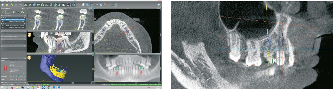 Abb. 10 u. 11: Dreidimensionale Planung der späteren Implantatpositionen.