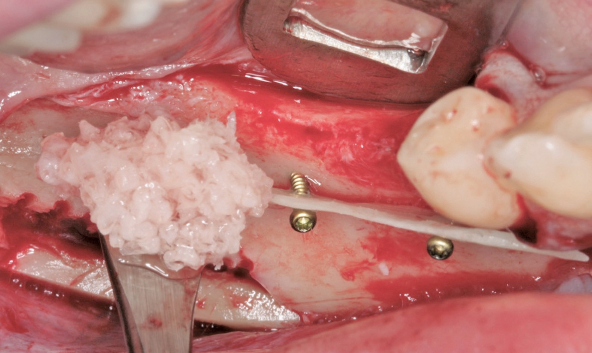 Abb. 11: Auffüllen des Spaltes mit vitalen Knochenspänen.