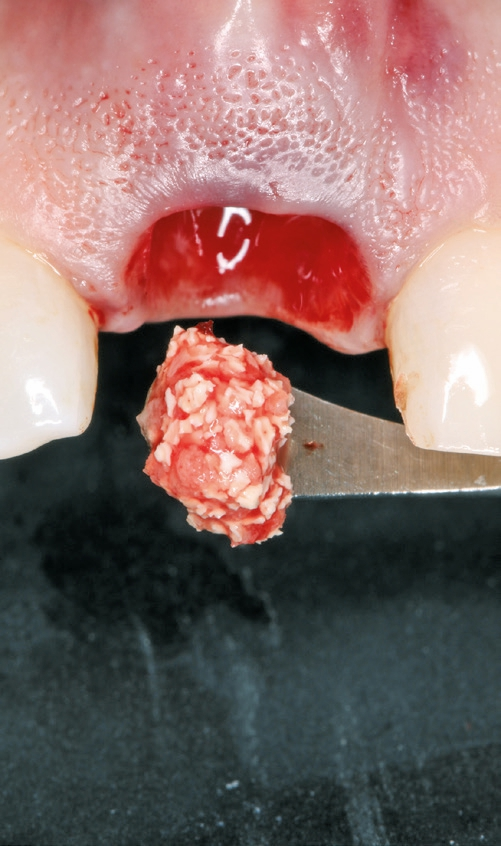 Abb. 9: Auffüllung des Spaltes zwischen eingesetztem Implantat und Alveole mit Biomaterial (Cerabone Granulat) und Eigenknochenspänen.
