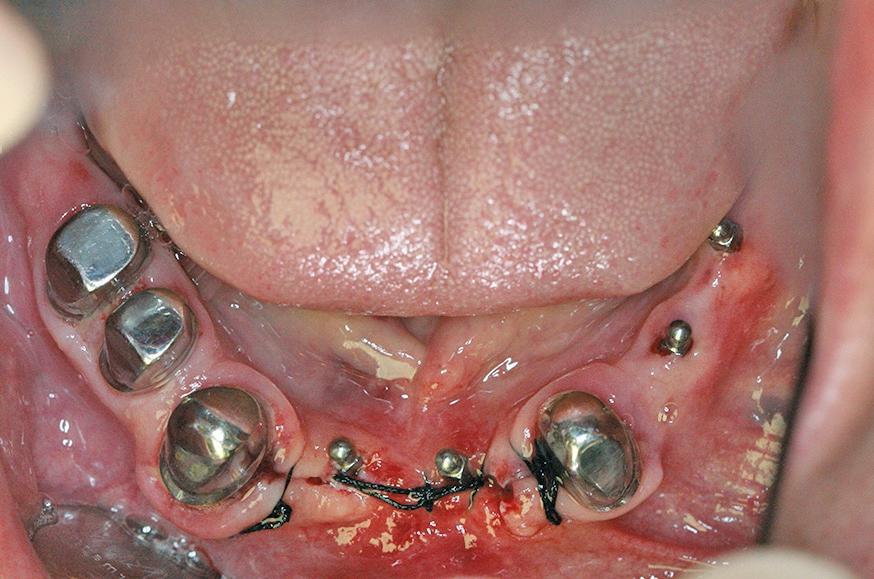 Abb. 8: Nach Insertion von MDIs in regio 35, 34, 31 und 41. In der Front wurde wegen des extremen Knochengrats ausnahmsweise offen implantiert, im 3. Quadranten wie gewohnt transgingival.
