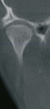 Abb. 10: DVT des rechten Kiefergelenks. Frontalschnitt durch den rechten Kondylus mit Darstellung der angrenzenden Gelenkräume. Auffallend sind die verengten Gelenkräume lateral und medial.