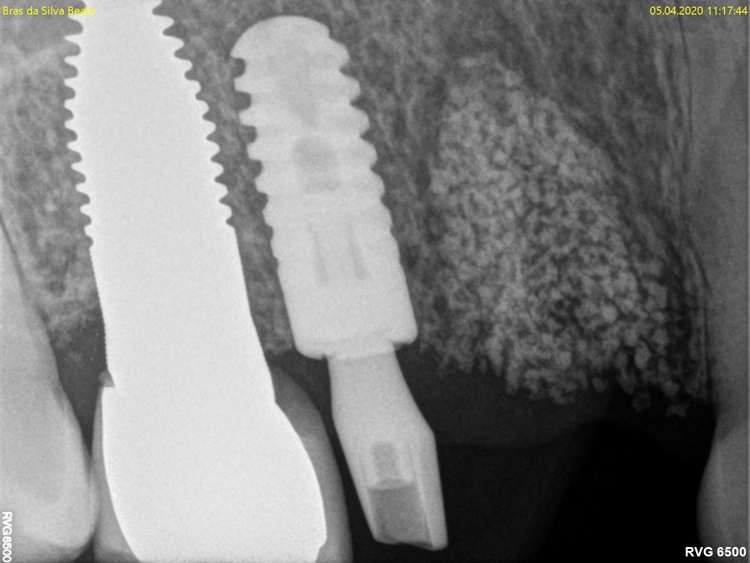 Abb. 11: Röntgenaufnahme vor Implantation an Tag 111 nach Socket/Ridge Preservation.