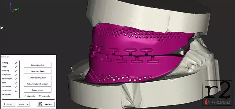 Abb. 11: Bissschablonen erstellt in BiteReg (r2 die ex machina).