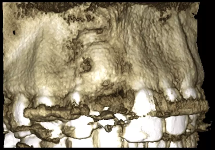 Abb. 11: Frontalansicht im DVT des augmentierten Defekts regio 11.