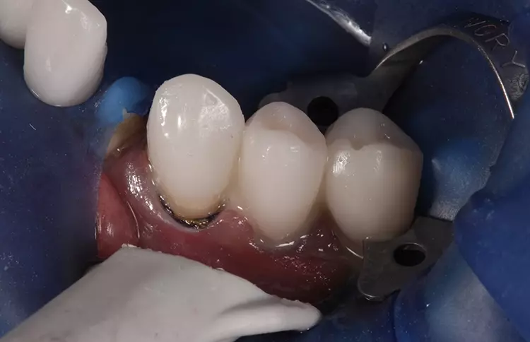 Abb. 11: Eingliederung der definitiven Versorgung im UK. Selektive Eingliederung
der zuvor geätzten und silanisierten (Monobond S, Silan, Ivoclar) Emax-Teilkronen
und Implantatkronen (Ivoclar) mit Syntac Classic (Ivoclar) und Variolink
Esthetic (Ivoclar) nach vorherigem Abstrahlen der präparierten Zahnoberflächen
(Rondoflex plus, Kavo) mit Aluminiumoxidpulver der Korngröße 27 μm (Rondoflex
plus, Kavo) und Schmelzätzung mit 35%iger Phosphorsäure (Ultraetch, Ultradent).