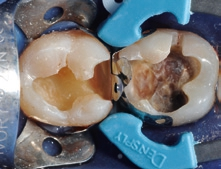 Abb. 15: Anlegen von Matrizen und Keil sowie dem Nickel-Titan-Ring.