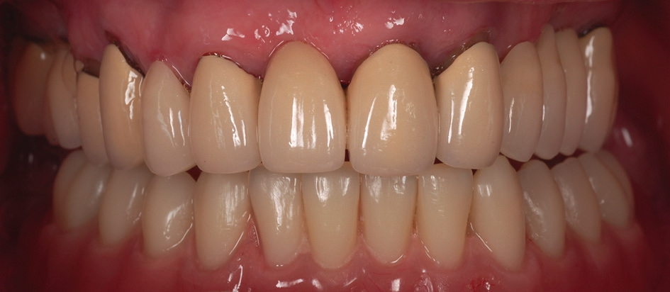 Abb. 12: Gutes ästhetisches und funktionelles Ergebnis der Cover denture-Prothese.