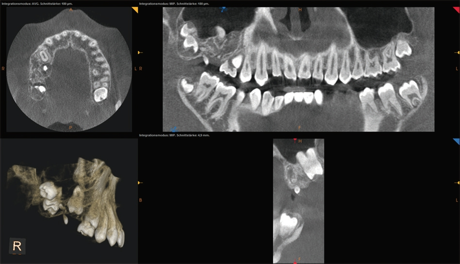 Abb. 6: Darstellung eines Odontoms regio 17, 16, 15, axial, coronal und sagittal.