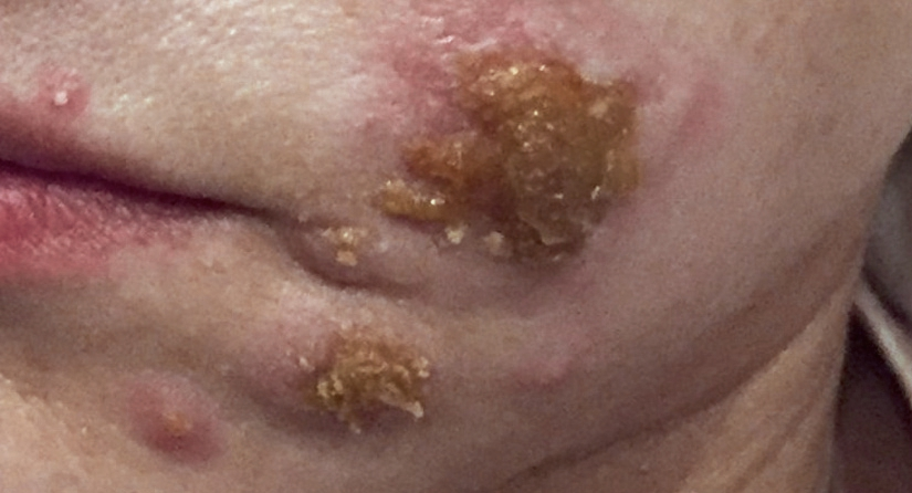 Abb. 10: Herpes zoster im Bereich des N. mandibularis links.