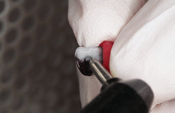 Abb. 11: Anstrahlen der Klebefläche mit Al2O3 50 ?m, 0,5 bar, Schutz der Verblendkeramik mit Pattern-Resin (GC Europe).