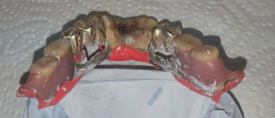 Abb. 11: Morgens um 10 zur Unterfütterung. Die Plaque sucht sich ihre Plätze. Auch bei Konstruktionen aus Metall.