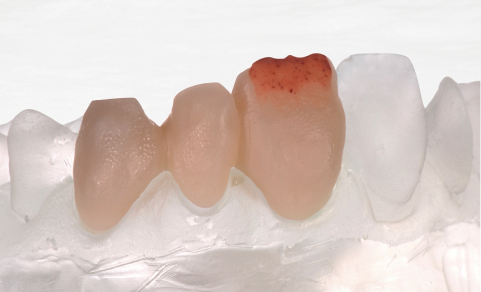 Abb. 10b: Das Gerüst wird mit DE 9, einem orangen, opakeren Dentineffekt, beschichtet.