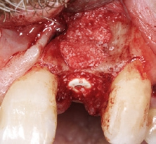 Abb. 11: Die laterale GBR erfolgte mit einem Gemisch aus autologen Knochenspänen und Bio-Oss Collagen. Abgedeckt wurde der Situs mit einer resorbierbaren Membran mit verlängerter Barrierefunktion.