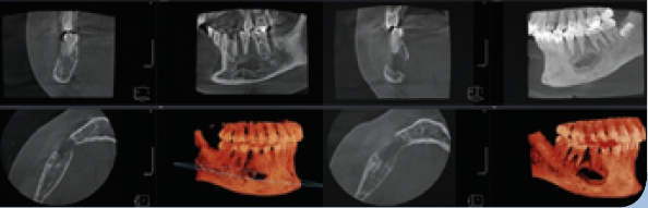 Abb. 14: MPR Ansicht DVT, zentrales Riesenzellgranulom 6 Monate postoperativ.