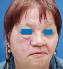 Abb. 17: 58-jährige Patientin.