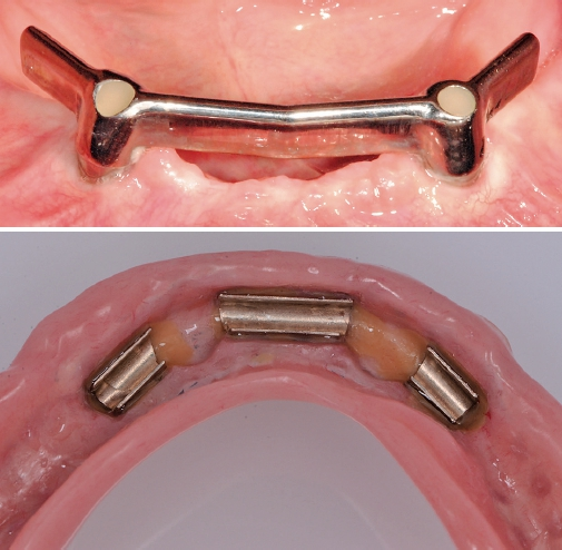 Abb. 11a u. b: Die Stegversorgung auf zwei Implantaten im stark atrophierten Unterkiefer, ist an den ZMK Bern die Versorgung der Wahl, wenn der Oberkiefer mit einer konventionellen Totalprothese versorgt ist und der Patient den Steg reinigen kann.