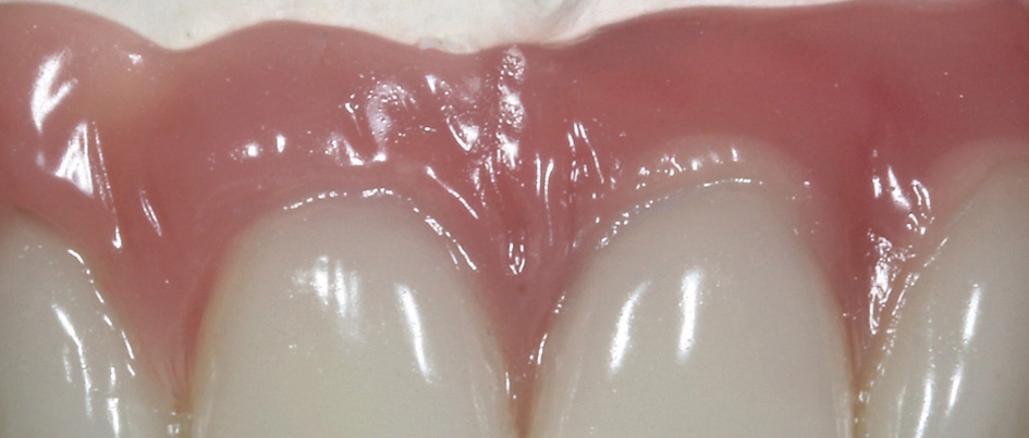 Abb. 13: Detail bei der Zahnfleischgestaltung. Natürliches Aussehen dank Lippenbändchen-„Kosmetik“.