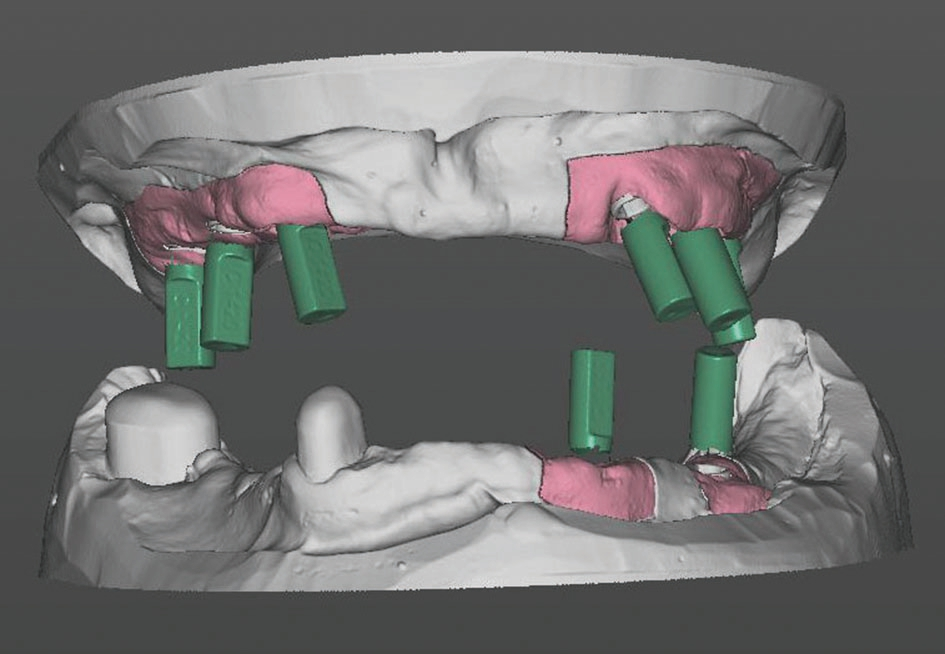 Abb. 20: Abutment-Scan auf Grundlage der Ästhetik-Anprobe. Konstruktion der individuellen Abutments.