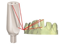 Abb. 13: Scanabutment für die extraorale Erfassung der Implantatposition über das Meistermodell.