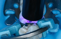 Abb. 11: Lichtpolymerisation des Haftvermittlers für 10 Sekunden.