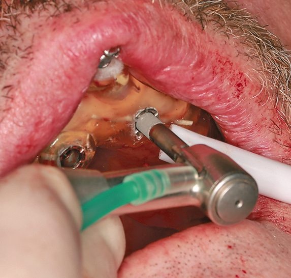 Abb. 11: Einbringen des Implantats nach Aufbereitung an regio 21 in die navigierte Position.