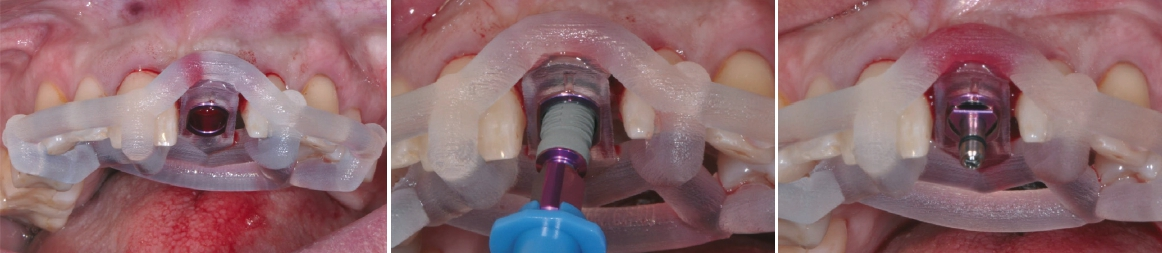Abb. 11: Insertion des Implantats (Camlog Conelog) mithilfe des Camlog Guide Systems.