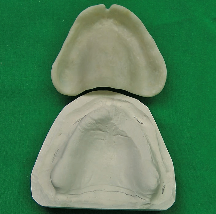 Abb. 6: ... und das Gleiche für den Oberkiefer.