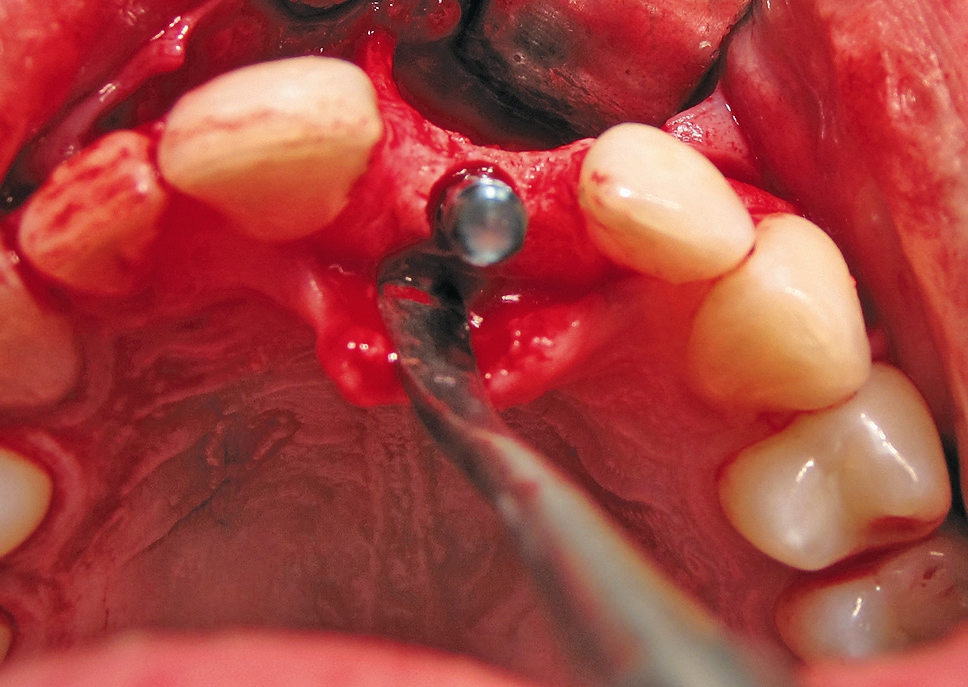 Abb. 9: Implantat in situ, Austrittwinkel von palatinal.