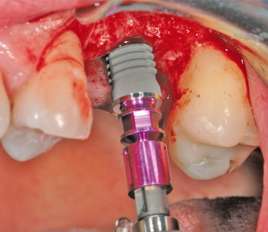 Abb. 11: Implantation: Insertion des Implantats an der optimalen Position gemäß Planung.