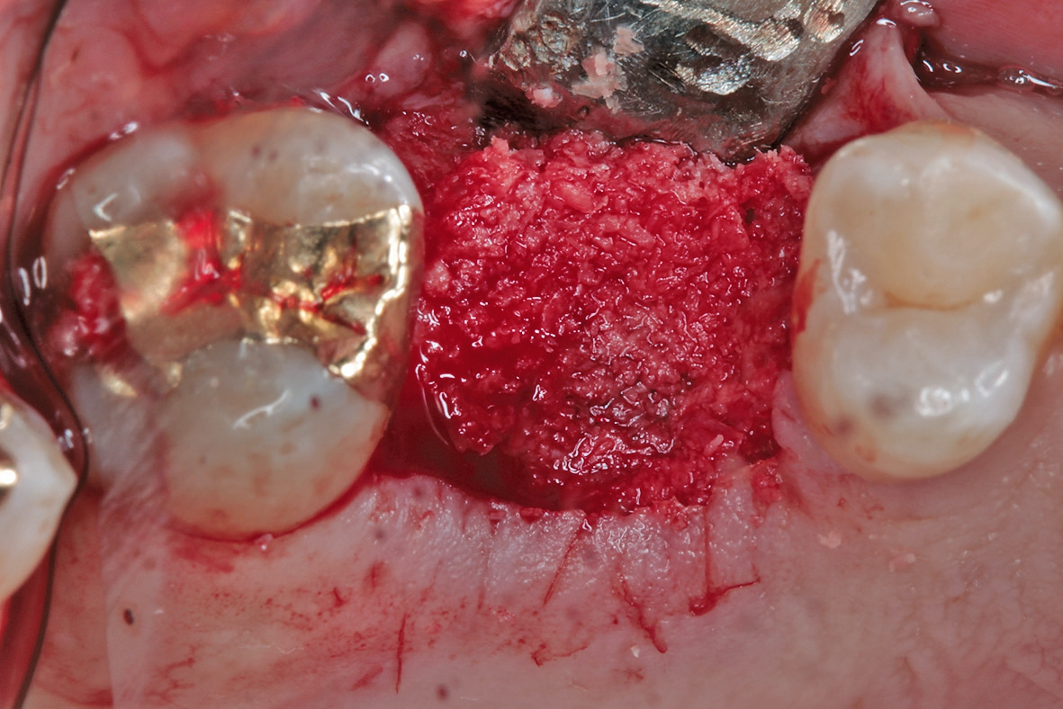 Abb. 11: Überschichtung des offenen Bereiches des Implantatlagers mit den bei der Implantatbettaufbereitung gesammelten Knochenspänen.