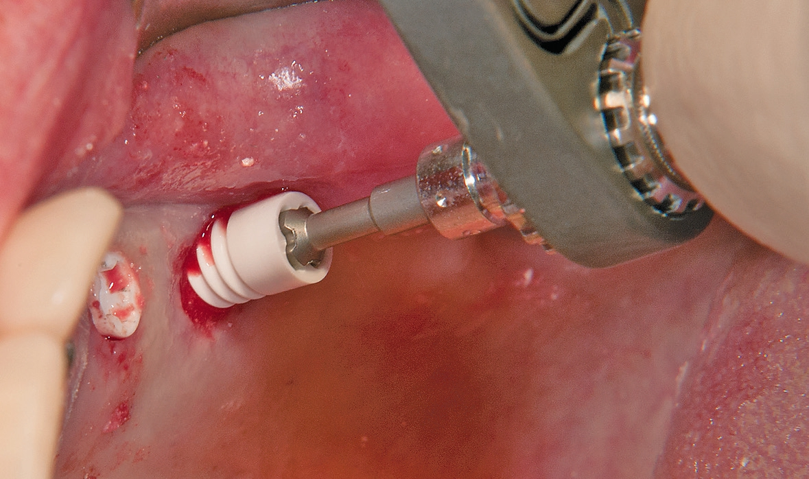 Abb. 11: Vorsichtiges Eindrehen des Implantats mit der Handratsche.