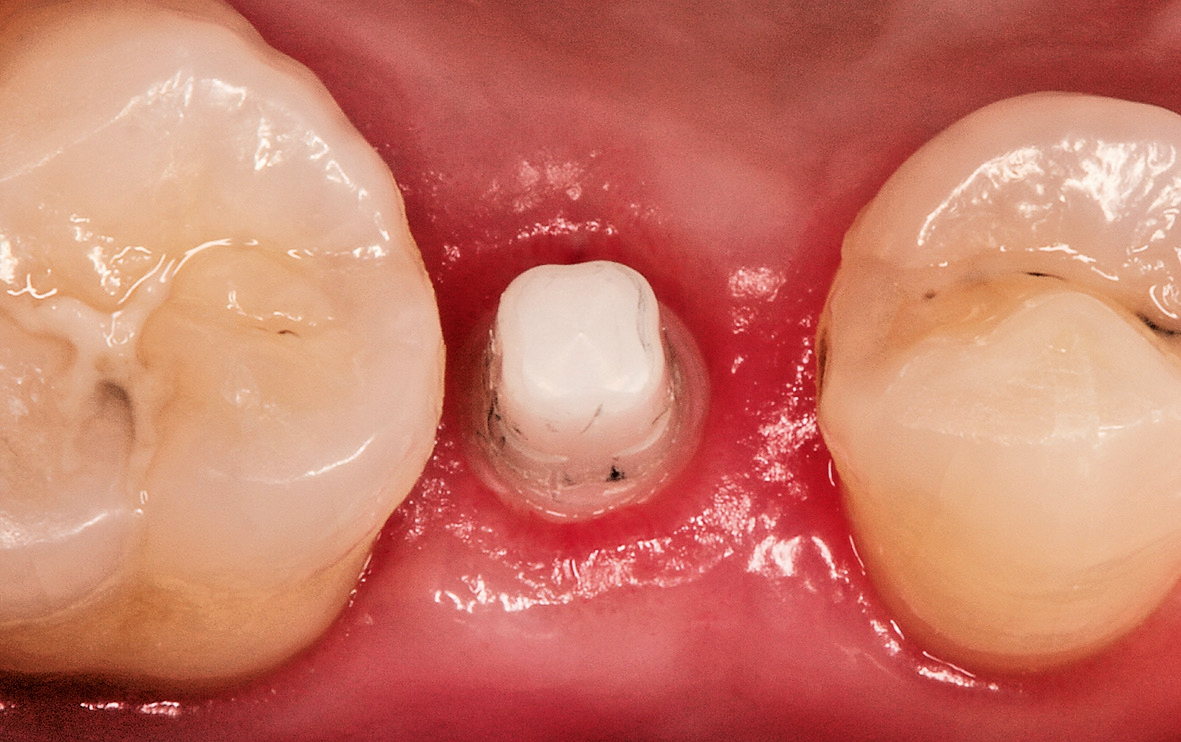 Abb. 11: Nach dreimonatiger Einheilung mit einem PMMA-Gingivaformer zeigt sich ein optimales Emergenzprofil.