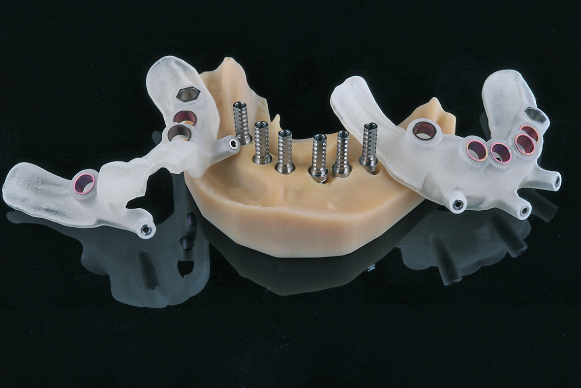 Abb. 7: Links die Bohrschablone, die durch den Restzahnbestand gehalten wird. In der Mitte das gedruckte Modell mit Modellanalogen und Prothetikaufbauten. Rechts die zweite Schablone nach der Extraktion.
