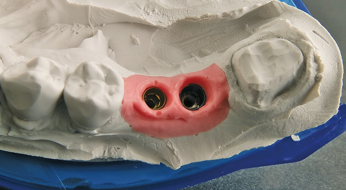 Abb. 35: Wie das Gipsmodell zeigte, musste die Stellung der Implantate aufgrund des vorgefundenen Knochenangebots noch etwas korrigiert werden.