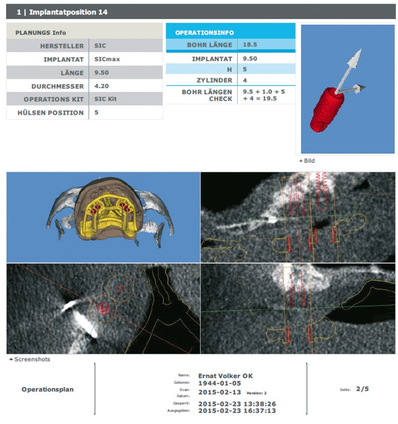 Abb. 15 und 16: Implantatplanung von sechs kurzen Implantaten (SICmax, SIC invent).