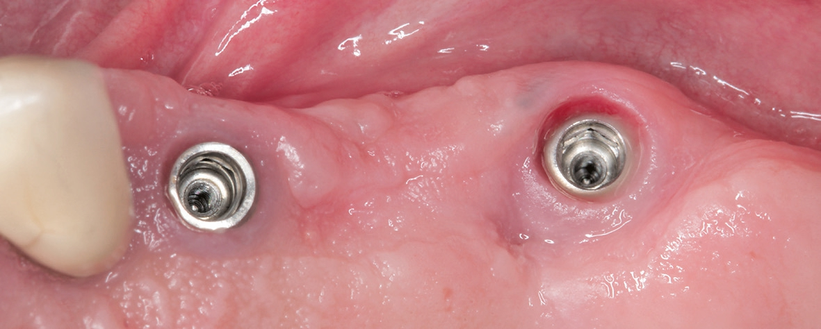 Abb. 13: Reizfrei abgeheilte periimplantäre Mukosa nach Entfernen der Gingivaformer.