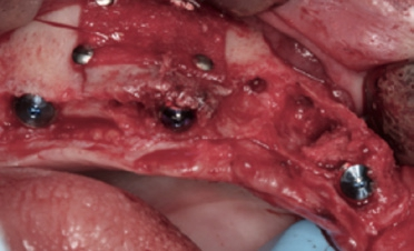 Abb. 11: Implantatinsertion und Sinuslift im Oberkiefer rechts.