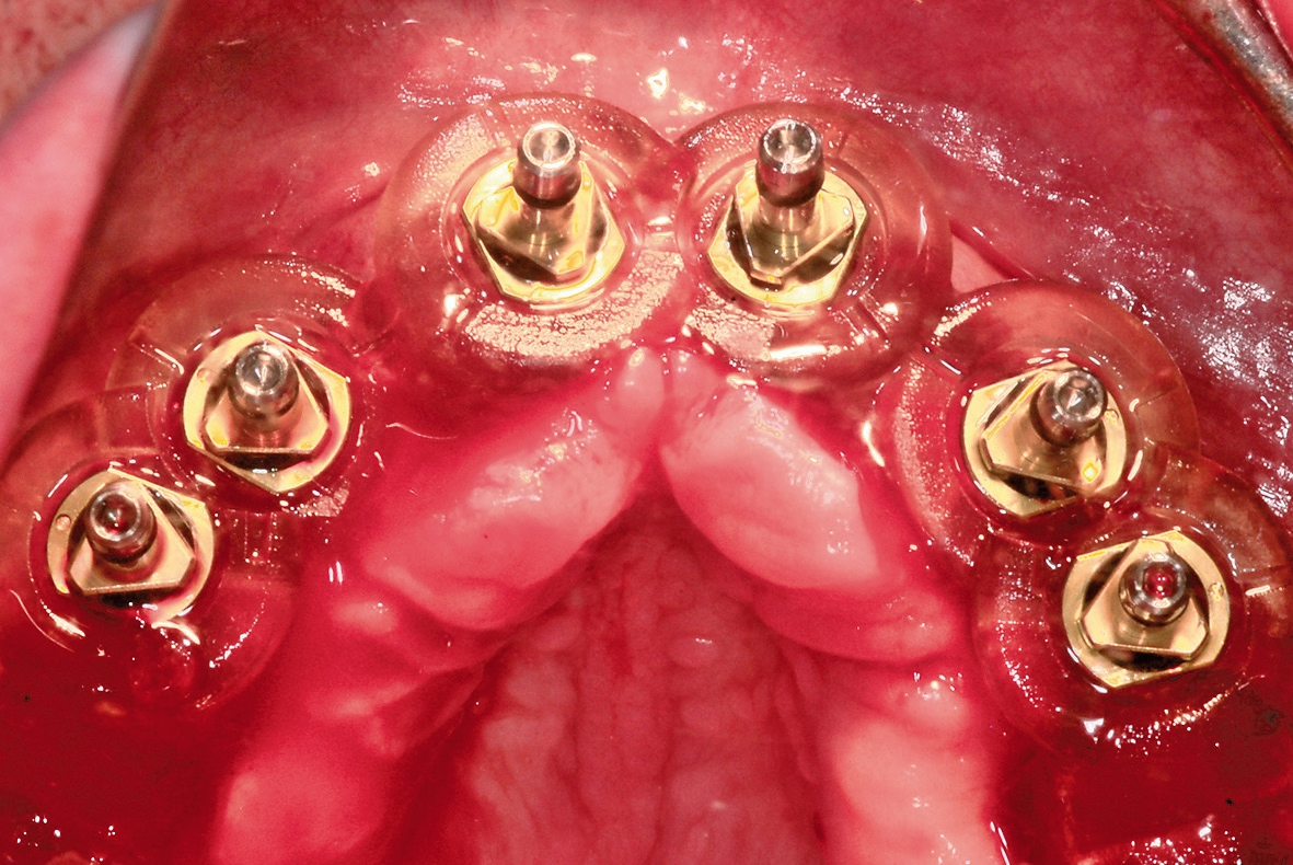 Abb. 11: Schablone mit inserierten Implantaten im Oberkiefer.