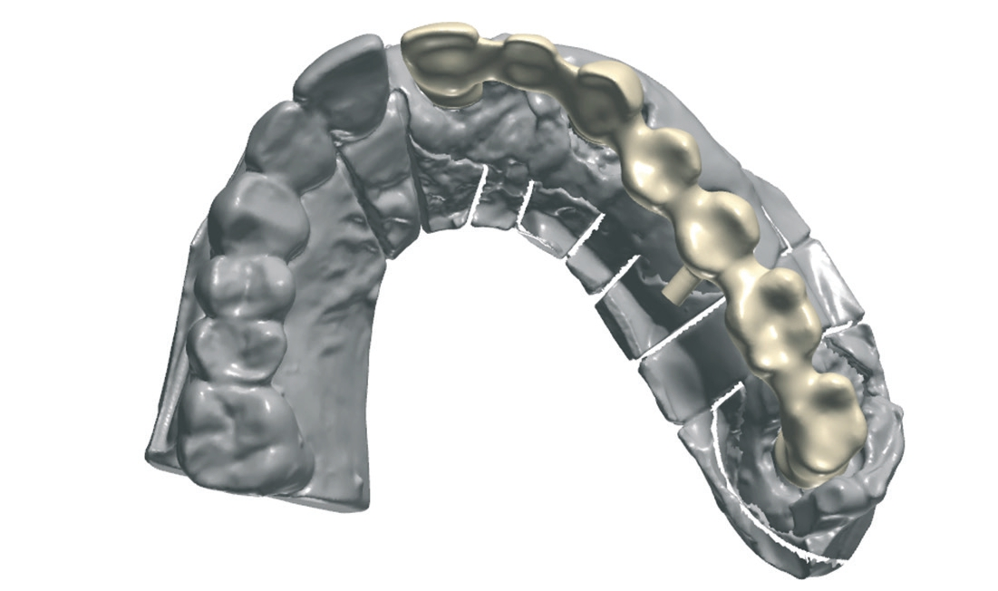 Abb. 11: Modell mit Zahnfleischmaske, die Abutments sind bereits montiert und beschliffen.
