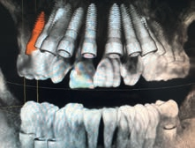 Abb. 13: 3D-Implantatplanung mit Versatz um eine halbe Zahnbreite zur Korrektur der Mittellinie.