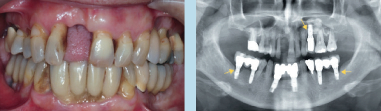 Abb. 7: Eine Quelle für Halitosis: Implantate in einer Mundhöhle mit unbehandelter Parodontitis.