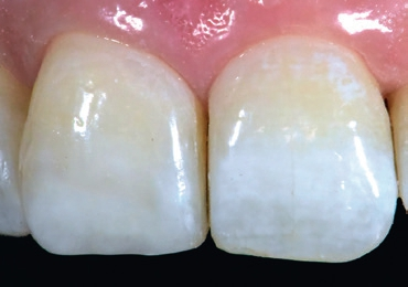 Abb. 11: Nach Konditionierung mit dem Pulverstrahlgerät wurde mit einer weiteren Überschichtung von weißlich eingetrübtem Flow (Venus Diamond, Bleach Extra Light [BXL], Kulzer) eine erste Farbanpassung vorgenommen.