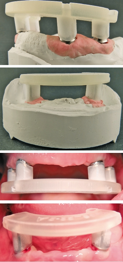 Abb. 73–76: Es wurden gedruckte Einsetzhilfen mitgeliefert, um die Abutments sicher und schnell einzugliedern und bei der endgültigen Fixierung mit dem Drehmomentschlüssel ein minimales Verdrehen der Abutments zu verhindern.