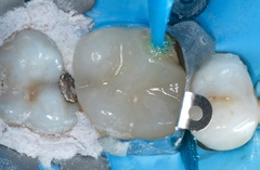 Abb. 12: Ein Universaladhäsiv mit Reparaturkomponente wird im Self-Etch-Verfahren auf sämtliche zu konditionierenden Frakturflächen (Keramik, Zahnhartsubstanz) aufgetragen.