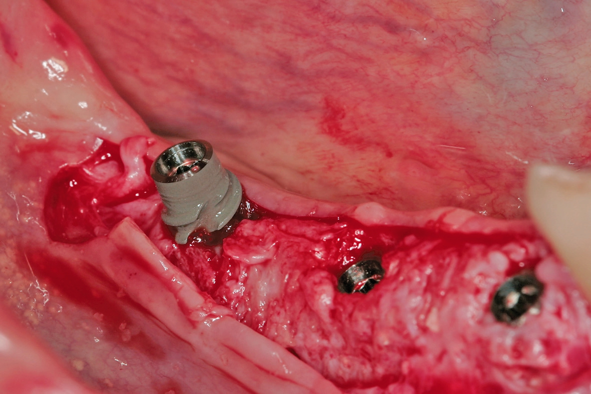 Abb. 13: Insertion der Implantate.