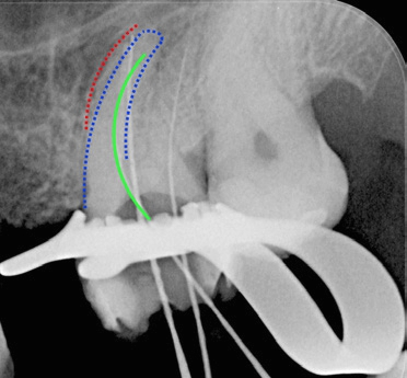 Abb. 10: Eine Röntgenmessaufnahme hilft beim Auffinden des mb2.