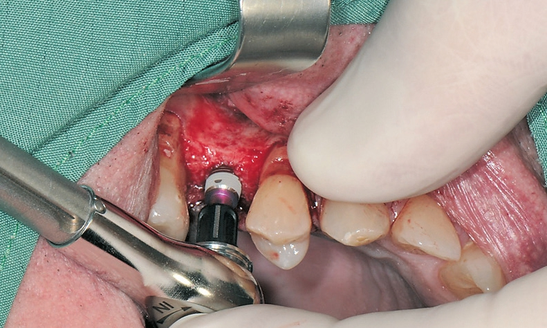 Abb. 10: Arretierung des Implantats mit Drehmomentratsche.
